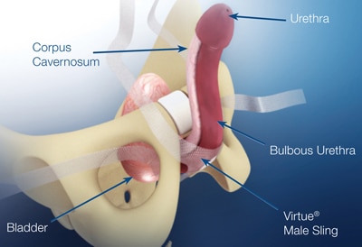 male sling surgery