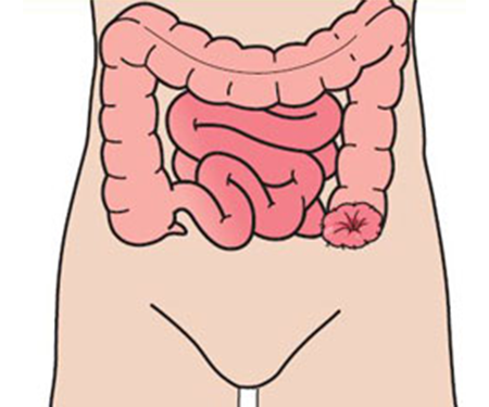 Colostomia