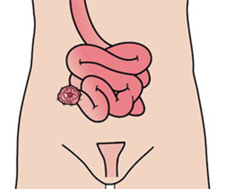 Ileostomia