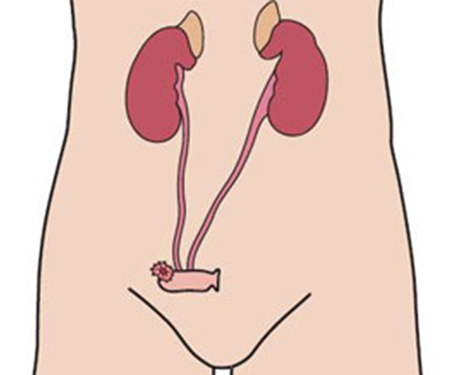 Urostomia
