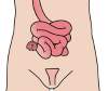 Ileostomia Ileostomia
