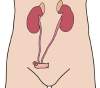 Urostomia Urostomia